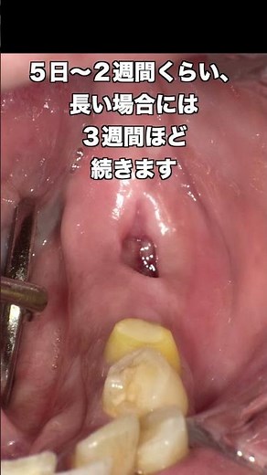 [Naito Dental Clinic in front of Totsuka Station] Dry socket #shorts #wisdom teeth