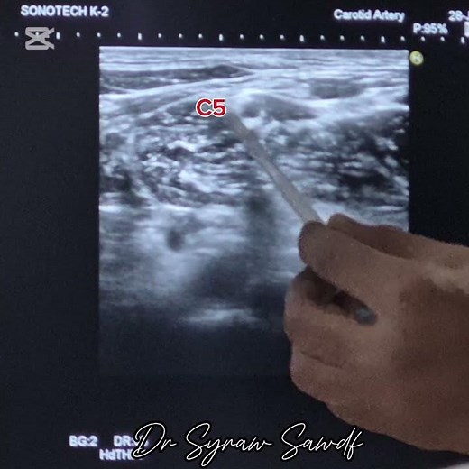 USG guided interscalene block for surgical fixation of fx proximal humerus by Dr Sairah sadaf