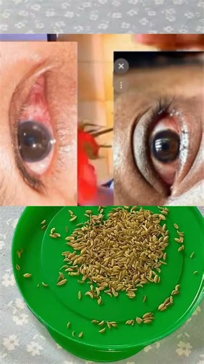 Any type of eyes problem #EyesSolution | Ayanfe olorun