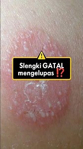 The SLENGKI area is itchy and peeling ⁉️😰 Here's the solution #healthfacts #education #uniquefact...