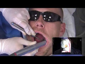 Case of the Week: Digital Obsidian® Crowns in One Day