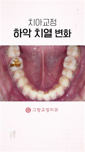 치아교정 중 하악 치열 변화 과정 #치아교정과정