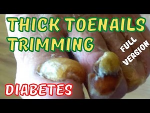 Yellow thick toenails trimming. Diabetes.