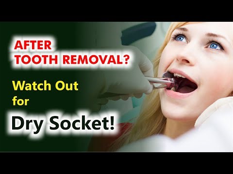 Dry Socket After Tooth Extraction? Causes, Symptoms & Fast Relief!