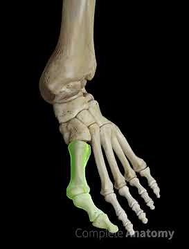 Bunion (Hallux Valgus)