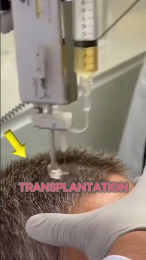 How to use the PRP machine on the head#shorts #PRP machine