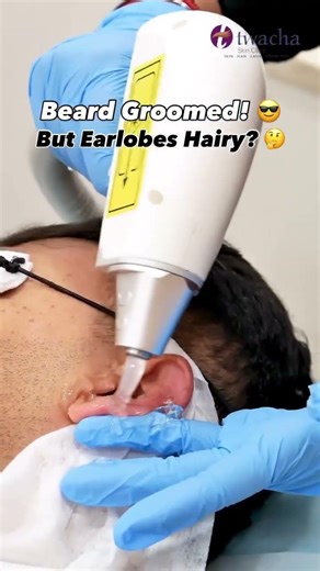 Unwanted Earlobe Hair? Laser Hair Reduction is the Solution!