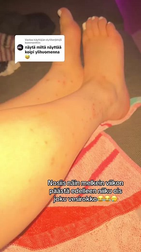 Vesirokon kaltaiset iho-oireet: Mitä ne kertovat?