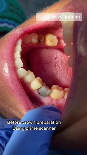 Same Day CEREC Crown Restoration Process Explained