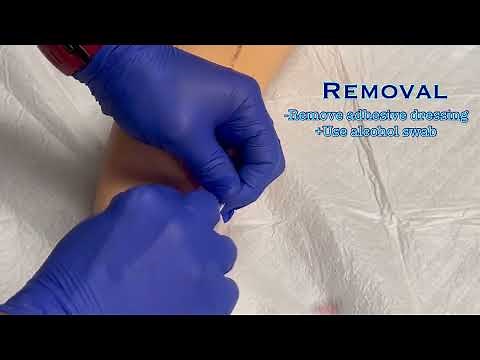 Peripheral IVs: Removing the IV