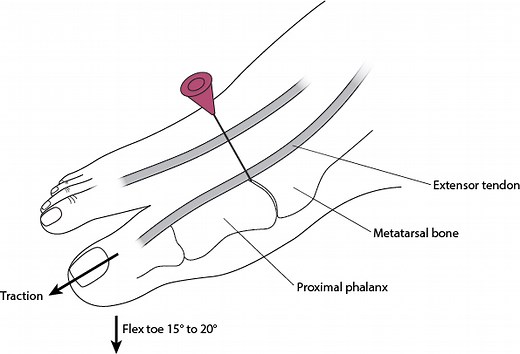 How To Do Metatarsophalangeal Joint Arthrocentesis - Musculoskeletal and Connective Tissue Disorders - MSD Manual Professional Edition