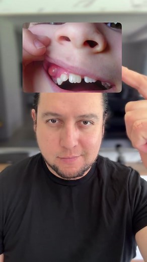 Absceso Dental Grave en Niños: Prevención y Riesgos
