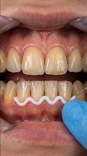 Laser Teeth Whitening Explained 🦷 Dental Animation & Results Overview