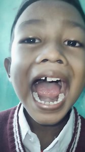baby tooth extraction | Jawer Asma