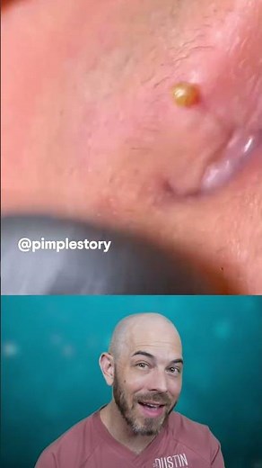 PAINFUL pimple pop on the lip line🤐 (credit: @pimplestory on TT) #pimple #reaction