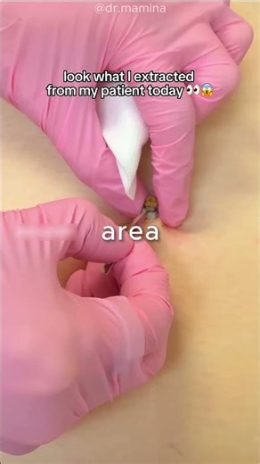 Why do they inject silicone into the belly button?🤔