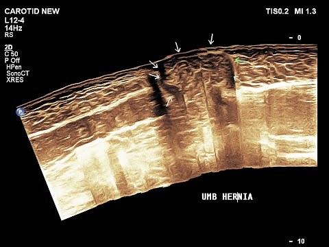 Umbilical Hernia || Ultrasound || Case 06