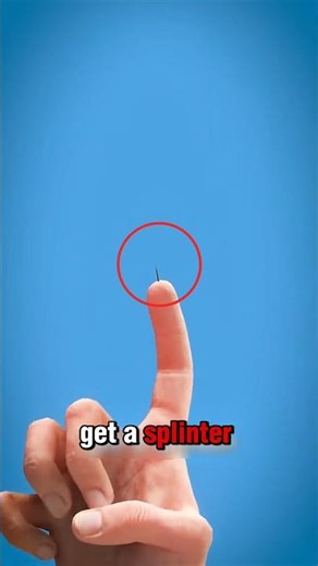 How to remove a Splinter‼️🤯