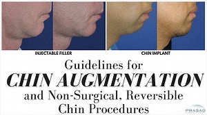 Basic Guidelines for Chin Augmentation, and Using Fillers Before Committing to Surgery