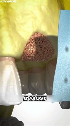 How Dentists Rebuild Missing Bone 😳 Real Process
