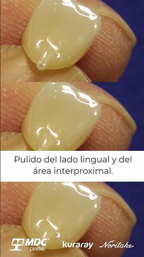 Tips Porcelana CZR Cerabien FC Paste Stain | Parte 1