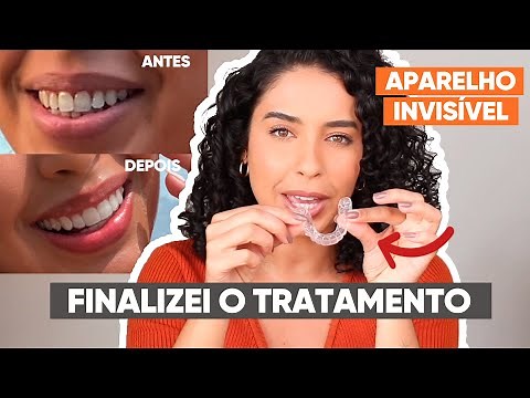 COMO MELHOREI MEU SORRISO USANDO APARELHO INVISÍVEL DA SOU SMILE | JULIANA LOUISE