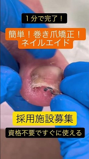 簡単！巻き爪矯正！ネイルエイド！繰り返し使えてリーズナブル
