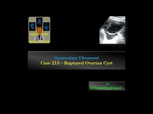Ultrasound Case 213 - Ruptured Ovarian Cyst