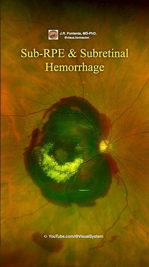 Sub-RPE & Subretinal Hemorrhage.