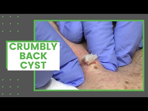 Crumbly Back Cyst | Dr. Derm