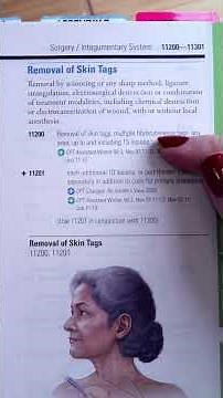 Medical Coding Demonstration - Skin Tags