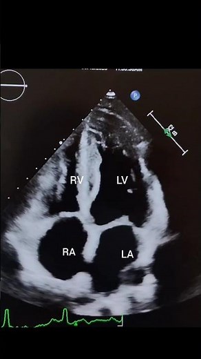 Basic Standard Echo View- Apical four chamber View (A4C).