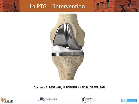 Chirurgie de l'arthose du genou : déroulement d'une prothèse totale de genou