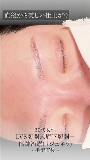 30代女性、LVS切開式眉下切開、傷跡治療（リジェネラ）、手術直後の動画です #Shotrs