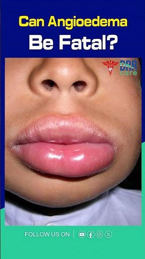 What Is Angioedema? Angioedema Diagnosis And Treatment | Respiratory Health #shorts