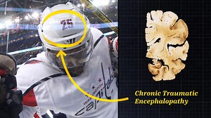 CTE: What is Chronic Traumatic Encephalopathy, its effect on football?