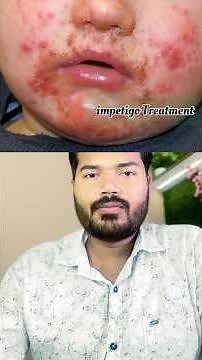 🦠 What is Impetigo? | Causes, Symptoms & Treatment Explained 💉