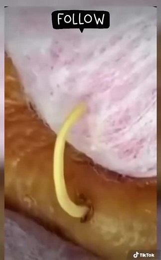 #limpiezas #extractions #extracciones #squeeze #acne #pimple #satisfaccion #satisfying #satisfaction #pimples #blackhead #blackheads #puntosnegros #espinillas #espinillasypuntosnegros #pop #pimplepop #acneremoval #granos #grains #poros #pimpleremover #pimpleremoval #pimpleremove #clean #cleaning #cleantok #SkinCare #relax #relaxingvideos #relaxing #popper #popperpimple #limpiezafacial#popper #viral#facial #flamentossebaceos #grano #granos #grains #limpiezafacial #estetik #relax #foryou#nariz #fy