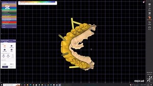 A very complex new case of a patient suffering from no parallelism in implant .There is no solution in multi-unit or angle implants due to the tilt of the implants. ‏We used Blender software to solve this problem at the lowest cost. ‏This work was done by. karam sadoon 🇮🇶 🙂‍↔️🙂‍↔️ #exocad #blender #bar #surgicalguideimplant #implant #exoplan #b4d #gingiva #gingiva #dsd #exocadexpert #design #iraq #🇮🇶 | Karam Sadoon