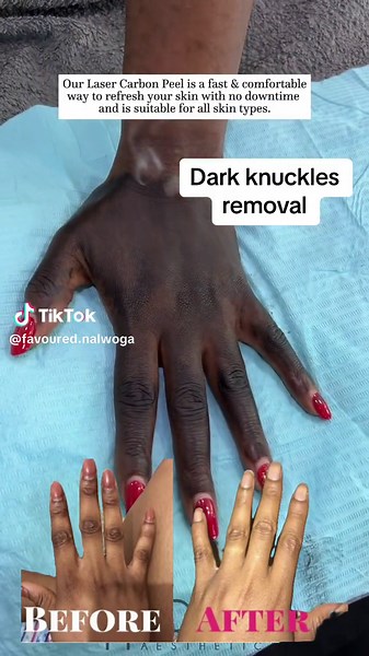 Effective Dark Knuckles Removal with Laser Treatment