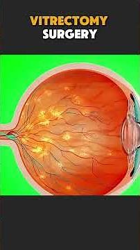 Vitrectomy Surgery Explained | Procedure, Recovery & Benefits #medicaleducation