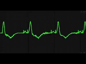 Telemetry Rhythm Pacemaker AV Sequential