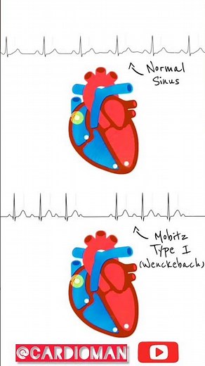 Heart Block👉 First-degree heart block, Second-degree (incomplete) , Third-degree heart block🫀