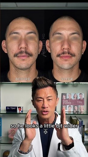 Jawline & Chin Filler for Men | Enhancing Facial Structure Naturally