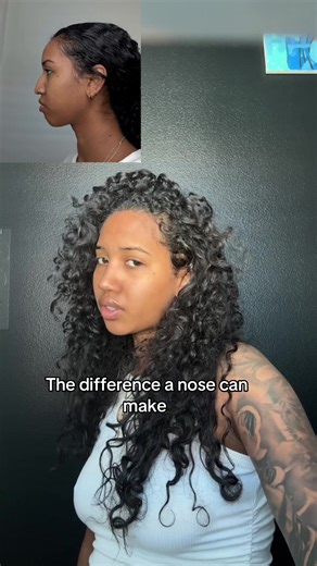 Transforming Lives with Ethnic Rhinoplasty in Turkey