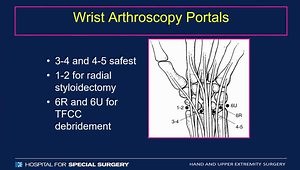 Acute Scapholunate Ligament Injuries