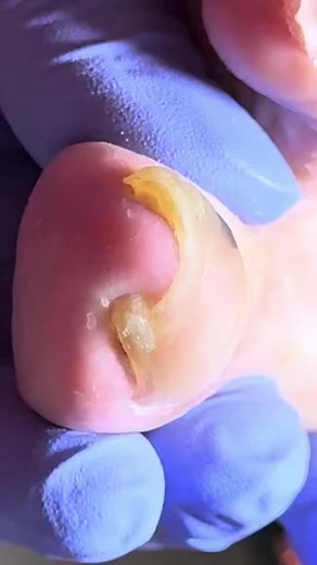 Wait till you see what’s inside this toenail ZWL6 Beautiful moments of care and relaxation through a gentle pedicure experience. Simple, clean, and satisfying. 🌿✨ Disclaimer: This video follows Fair Use (Section 107) for educational and informational purposes. Clips are from public Chinese sources where Facebook isn’t available, causing no commercial harm. All content is transformed for awareness and not intended to infringe copyright. | Naboli 4