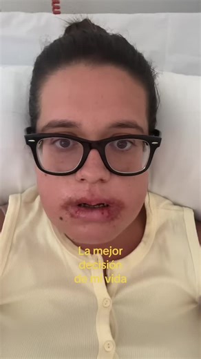 Transformación de labios: mi experiencia personal