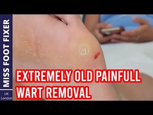 Extreme Old Painful ** DEEP WART ** REMOVAL FULL TREATMENT BY MISS FOOT FIXER