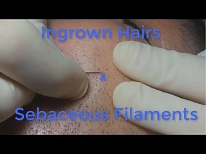 Ingrown Hairs and Sebaceous Filaments